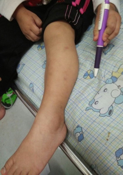 揪心的小腿