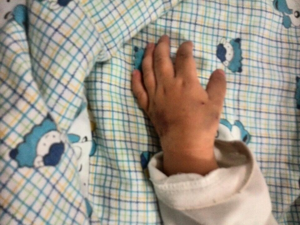 布满针眼青紫的小手